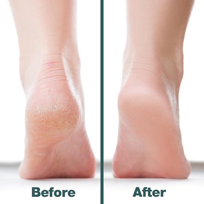 Probelle Double Sided Multidirectional Nickel Foot File Callus Remover - Immediately Reduces calluses and Corns to Powder for Instant Results, Safe Tool (White)