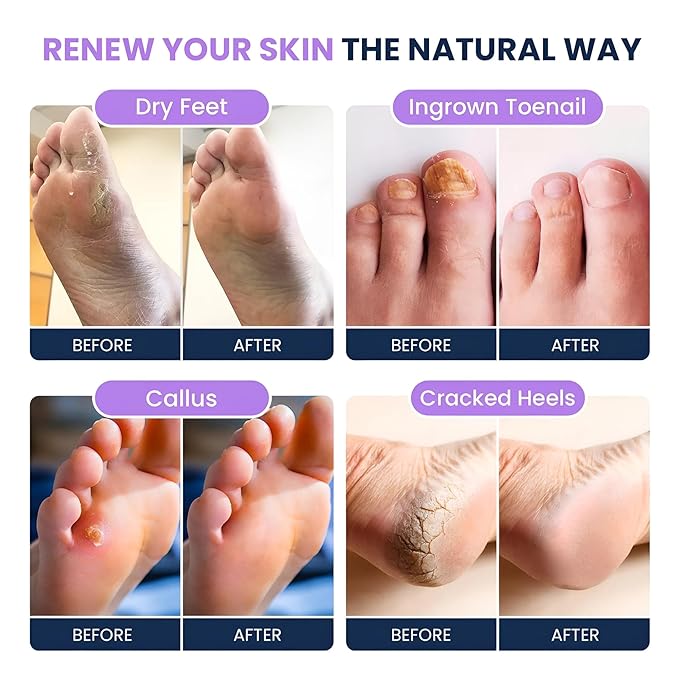 FOOT CURE Tea Tree Oil & Soothing Lavender Foot Soak with Epsom Salt - Best Toenail Treatment & Softens Calluses - Soothes Sore & Tired Feet, Foot Odor Scent, Spa Pedicure - 16 oz (Pack of 2)